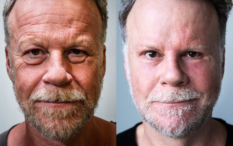 Jenke von Wilmsdorffs extremstes Experiment: Der 55-jährige Reporter wollte 20 Jahre jünger aussehen und ließ sich - zum besseren Vergleich - zwei Hälften seines Gesichts mit kosmetischen versus operativen Methoden verändern.